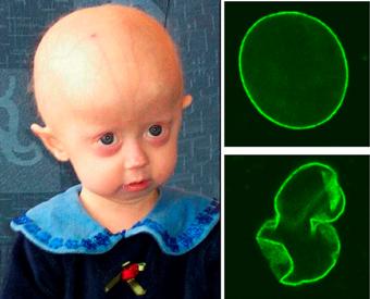 20110305051701-hutchinson-gilford-progeria-syndrome.jpg