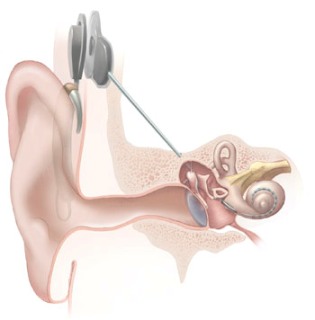 20111029130110-cochlear-implant.jpg