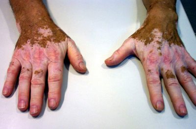 20150330131637-vitiligo.jpg